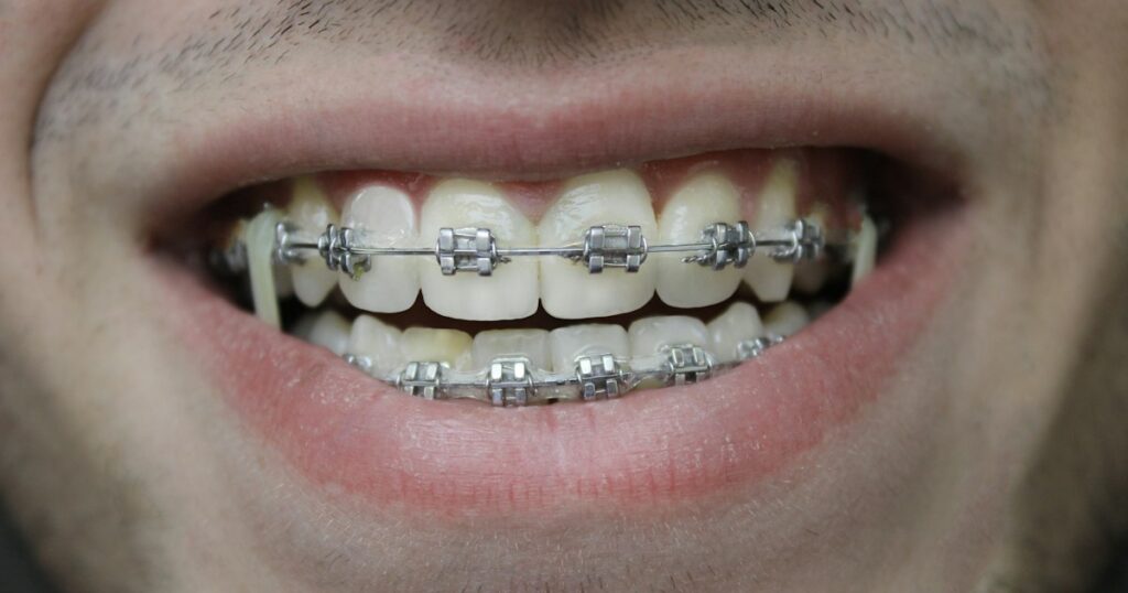 Primer plano de una sonrisa con brackets metálicos y arco en ambas arcadas