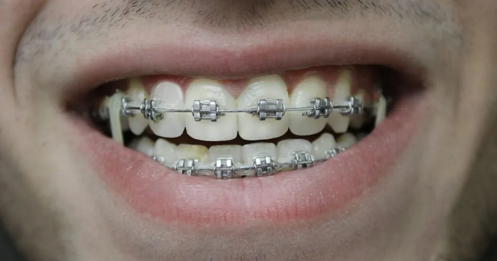 Primer plano de una sonrisa con brackets metálicos y arco en ambas arcadas