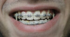 Primer plano de una sonrisa con brackets metálicos y arco en ambas arcadas