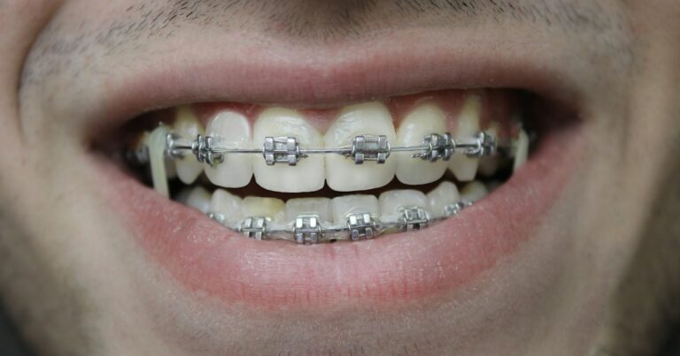 Primer plano de una sonrisa con brackets metálicos y arco en ambas arcadas