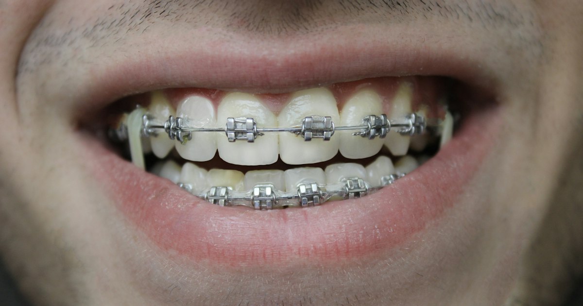 Primer plano de una sonrisa con brackets metálicos y arco en ambas arcadas