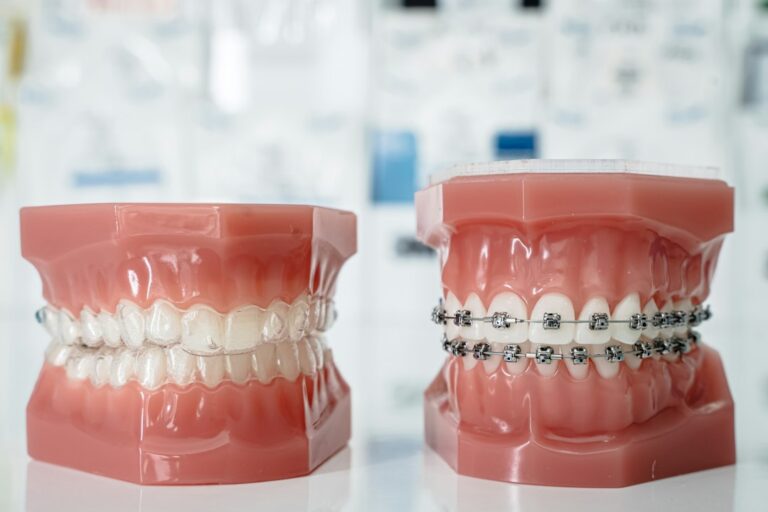 Illustrative models showing clear aligners and braces.
