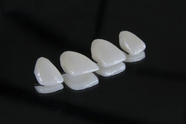 Illustrative example of ceramic veneer restorations.
